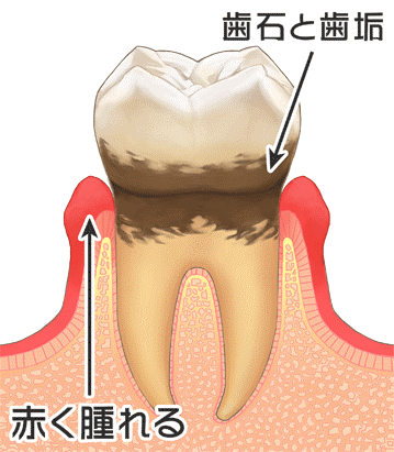 歯肉炎・歯周炎（歯槽膿漏