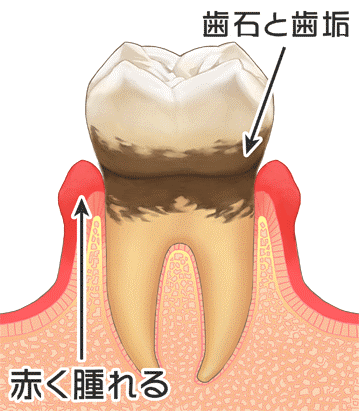歯肉炎・歯周炎(歯槽膿漏