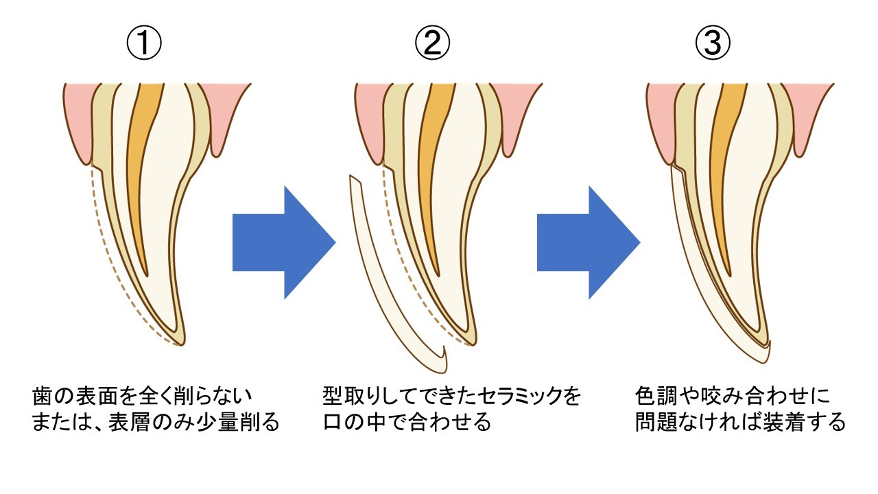 ラミネートベニア