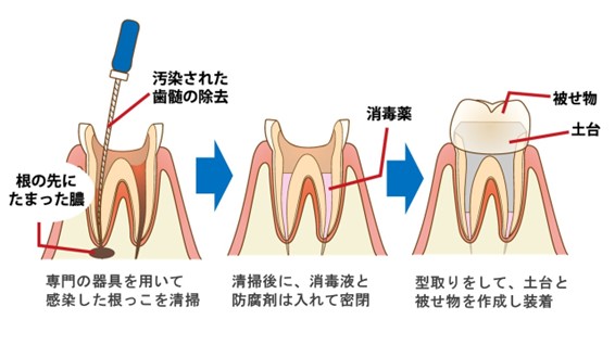 虫歯の治療