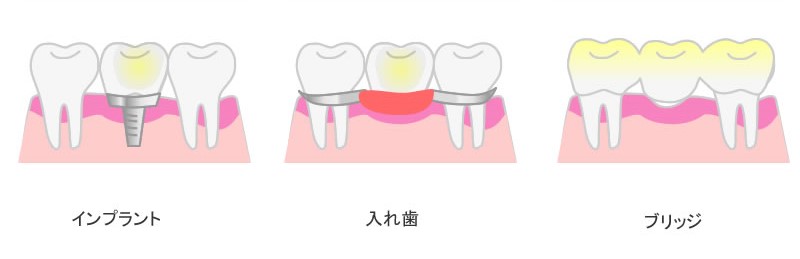 残っている歯に負担を掛けない