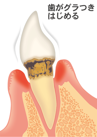 中等度の歯周炎