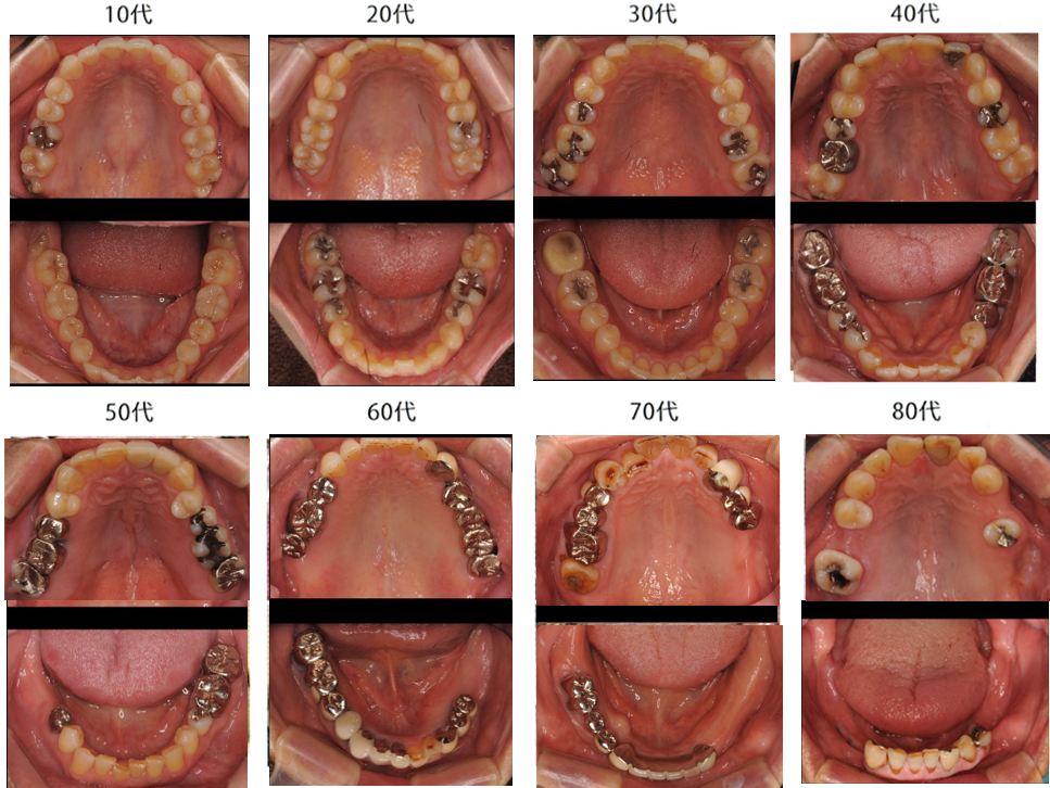 H28年度厚生労働省の歯科疾患実態調査