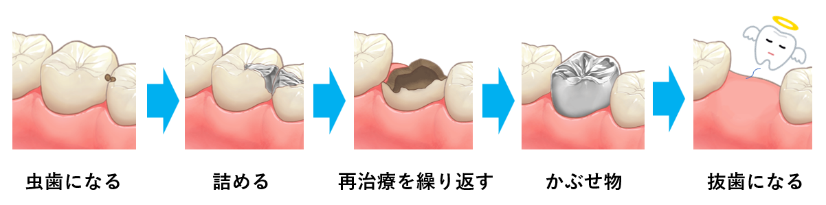 従来の虫歯治療の過程