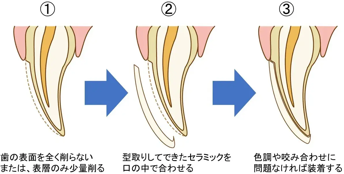 ラミネートベニア