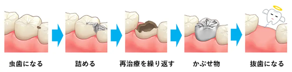 なるべく削らない虫歯治療