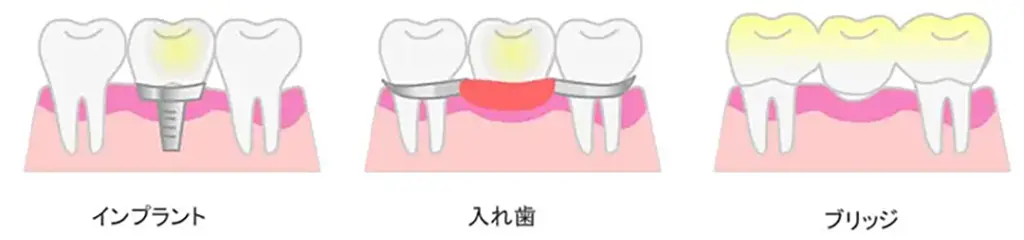 残っている歯に負担を掛けない