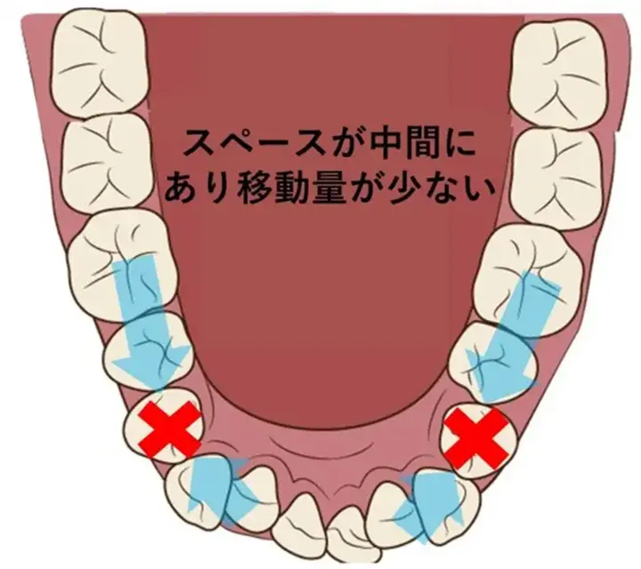 一般的に抜歯矯正は治療期間が早く終わるため