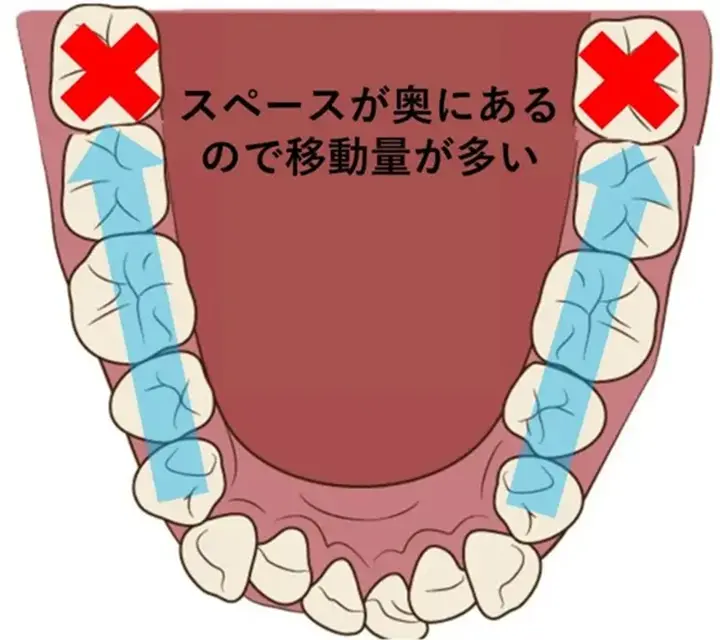 一般的に抜歯矯正は治療期間が早く終わるため