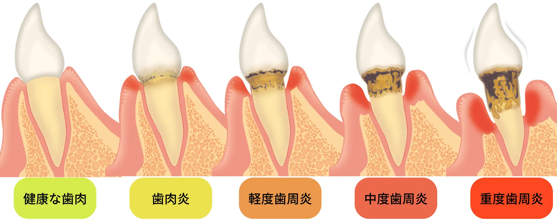 歯周病の分類