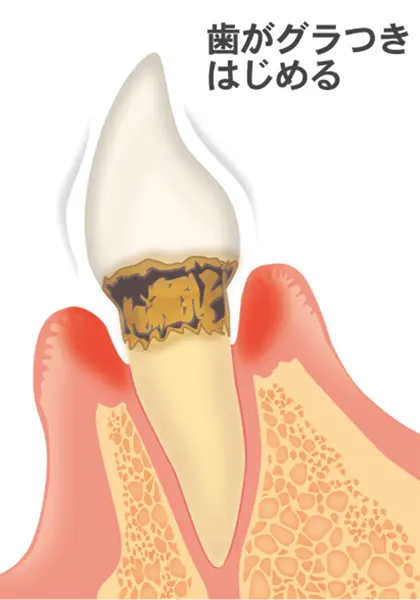 中等度の歯周炎