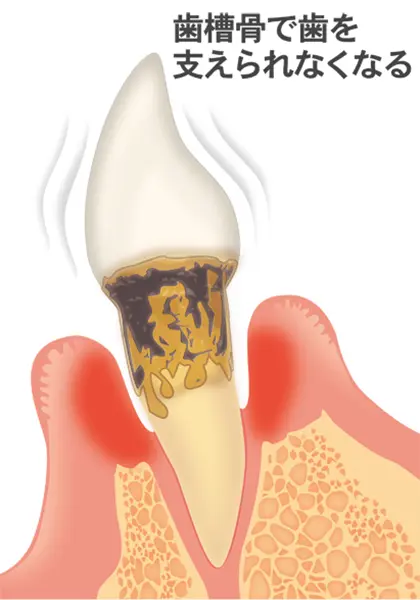 重度の歯周炎