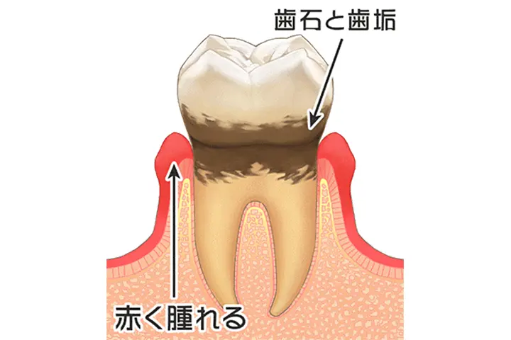 歯肉炎・歯周炎（歯槽膿漏）の方