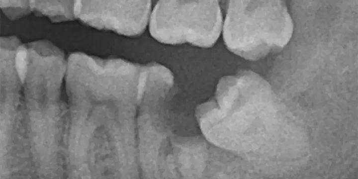 親知らずは抜歯した方が良い？