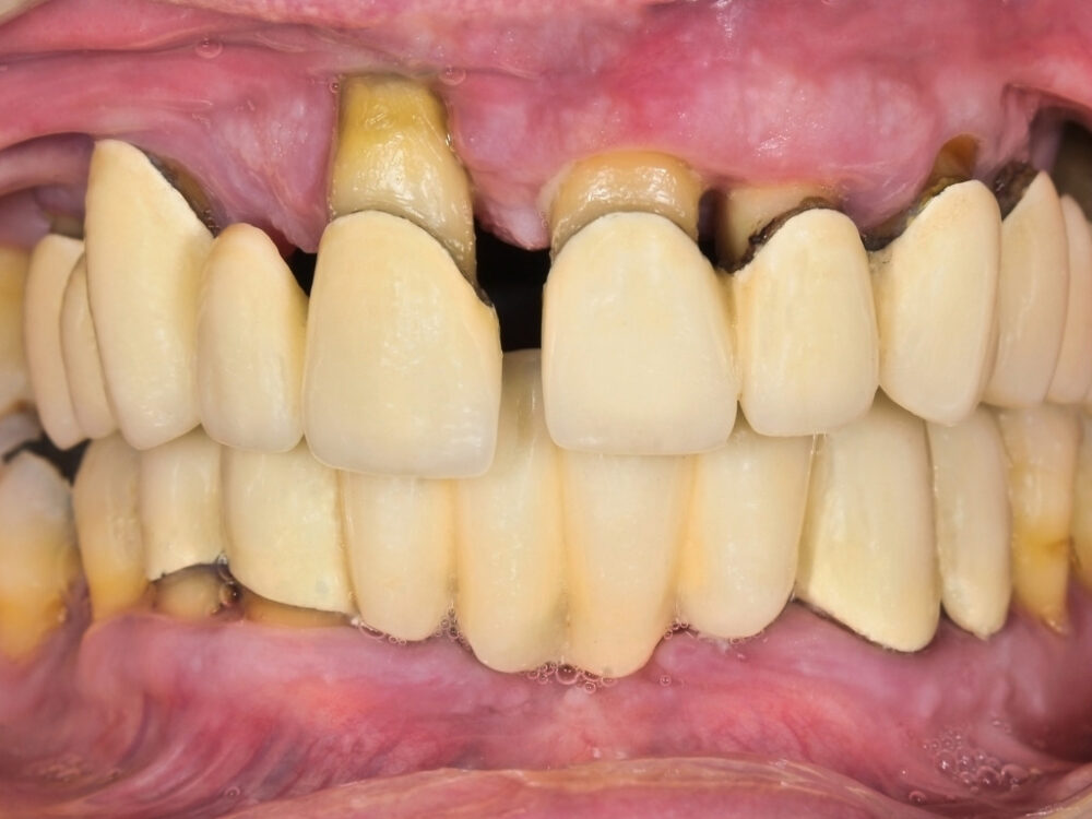 歯周病は完治しにくく、再発しやすい病気。