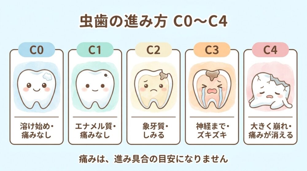 虫歯の進み方 C0からC4。C0は溶け始めで痛みなし、C1はエナメル質で痛みなし、C2は象牙質でしみる、C3は神経までズキズキ、C4は大きく崩れて痛みが消える