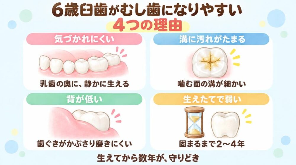 6歳臼歯がむし歯になりやすい4つの理由。気づかれにくい、溝に汚れがたまる、背が低い、生えたてで弱い