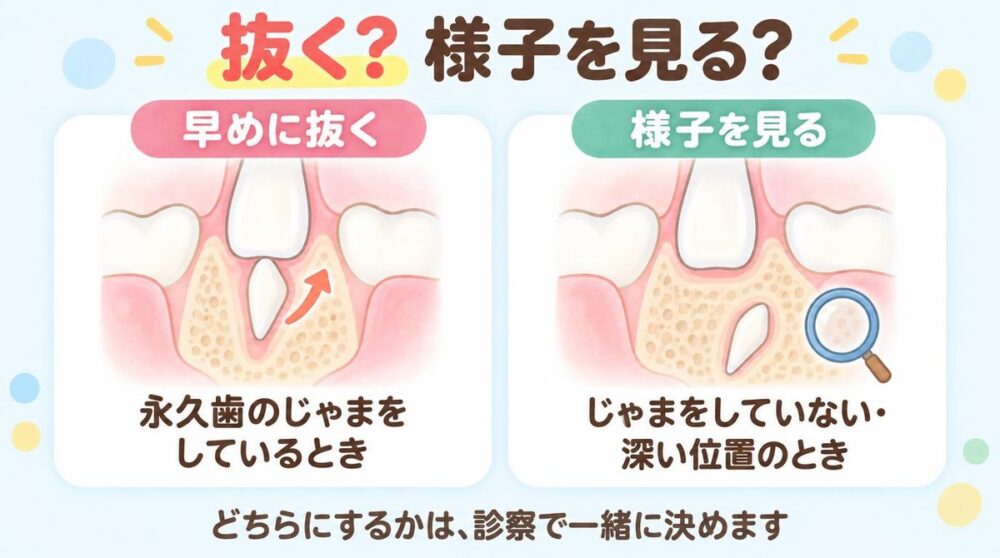 過剰歯を早めに抜くのは永久歯のじゃまをしているとき、様子を見るのはじゃまをしていない・深い位置のとき