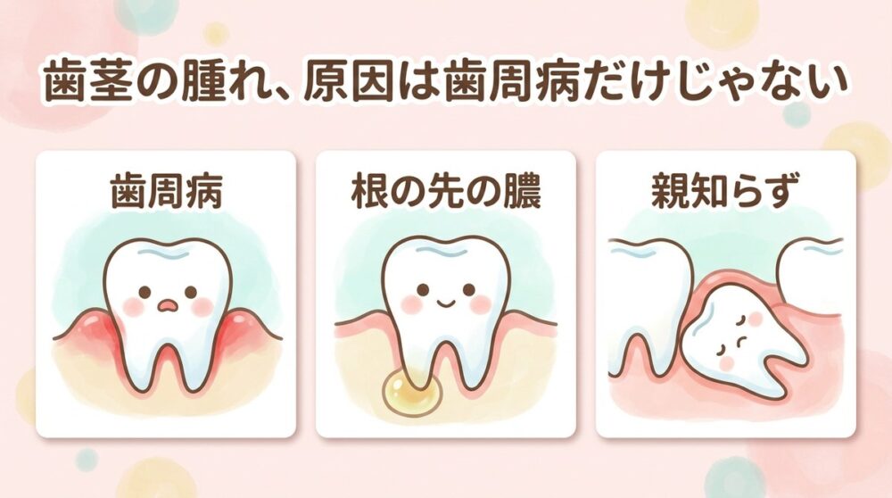 歯茎の腫れの3つの原因、歯周病・根の先の膿・親知らずのイラスト
